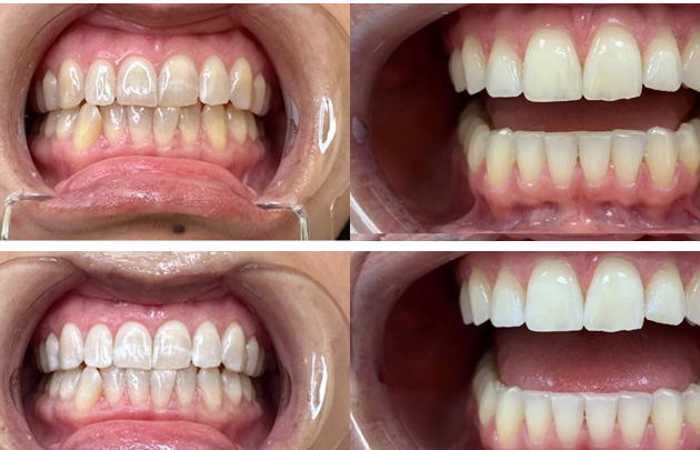 Before and after teeth whitening results showing dramatic shade improvement