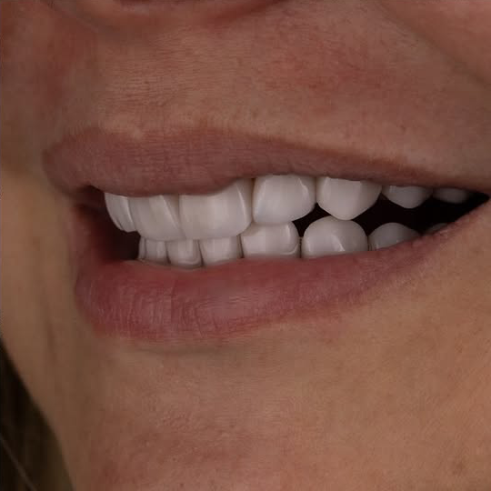 After treatment