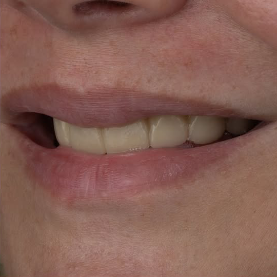 Before treatment