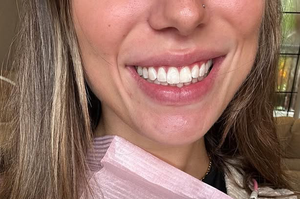Professional Teeth Whitening